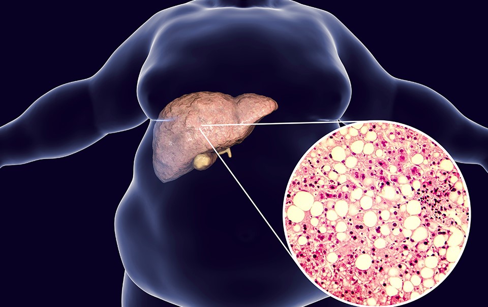 Liver Disease