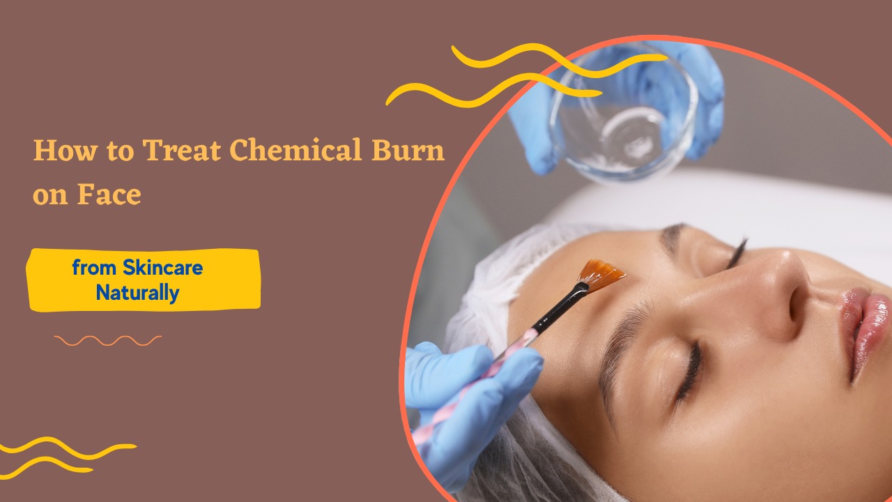 How to Treat Chemical Burn on Face from Skincare: Naturally post thumbnail image